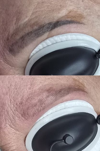 PMU Verwijderen PMU Verwijderen